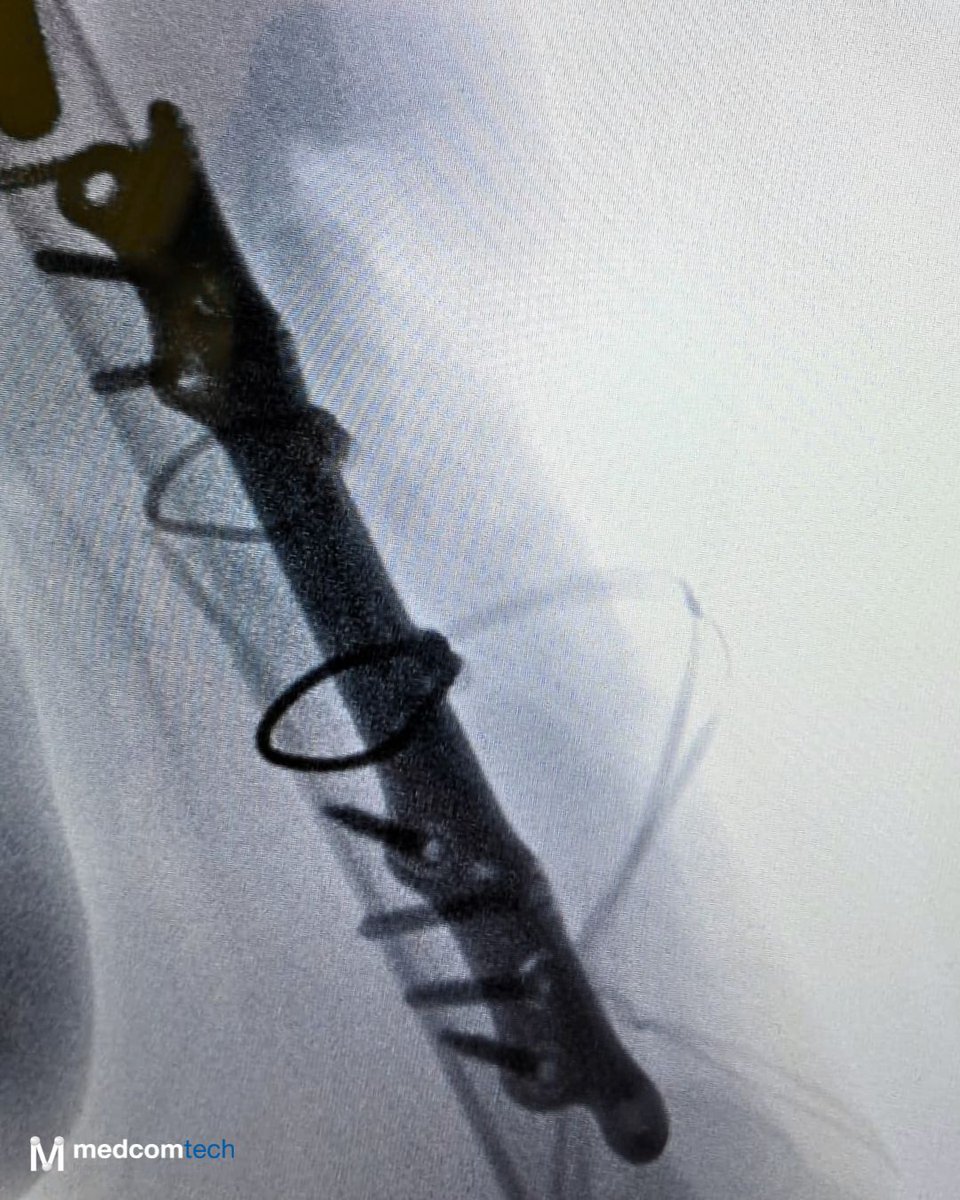 medcomtech_sa's tweet photo. Primer caso en el H. Arnau de Vilanova (Lleida) con placa periprotésica de húmero proximal de Intrauma. 
Intervención exitosa de la Dra. Bonjorn y el equipo EESS.
#traumatología #húmero #cirugíaortopédica #intrauma https://t.co/0NQu0Dyg3R