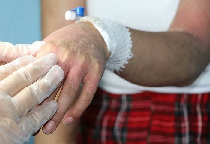 bpthaber's tweet photo. HASSAS | Van'da “cilt beyazlatıyor” vaadiyle tanıtılan bir kremi satın alıp kullanan genç kız, 4 gün yoğun bakımda kalıp ölümden döndü. https://t.co/aB3LZZxCRU