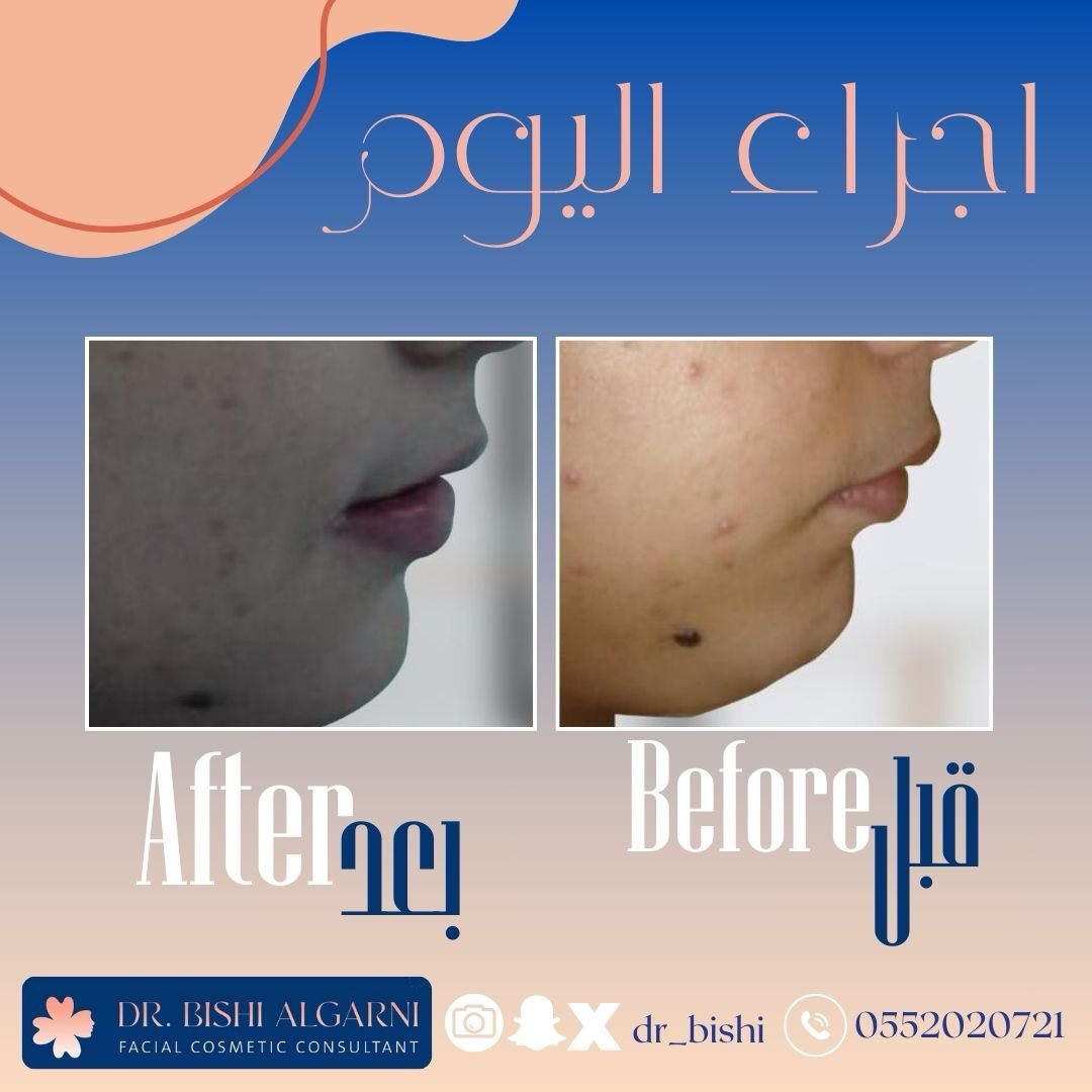 #التعديل_الجراحى تقديم الفك السفلي و الذقن و تحسين ميلان الوجه