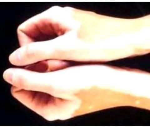 ShivamAyurved's tweet image. #vitiligo #leucoderma isn't a life-threatening disease, but it puts patient in shameful position, with the help of our Ayurvedic treatment, vitiligo can be cured completely. call and WhatsApp wa.me/918690434573 Gujarat India #श्वित्र #सफेद #विटिलिगो #ल्युकोडर्मा #स्किन #Skin