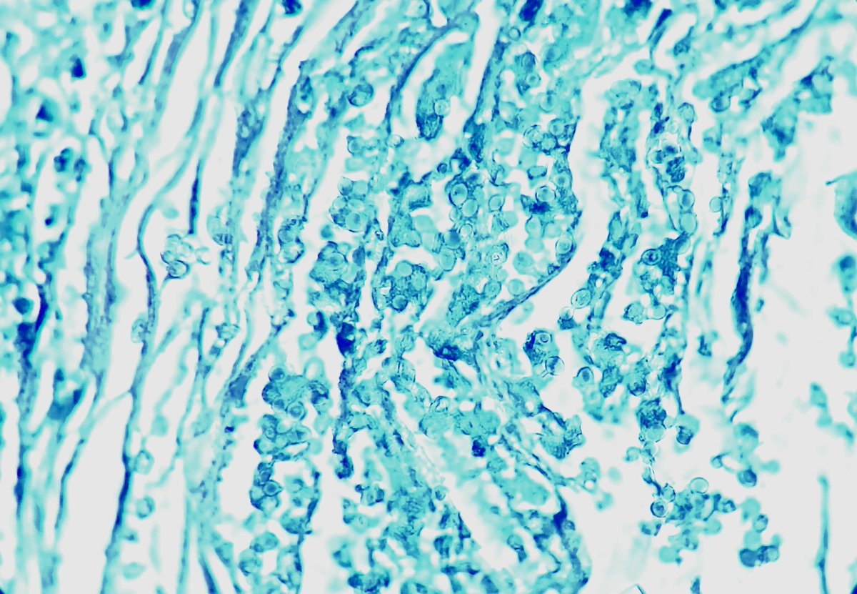 A 24 Yr | 👩
❄️Esophageal Extensive whitish plaques
 ➀ Parakeratotic SSE
 ➁ Spongiosis
 ➂ Fibrinopurulent exudates &amp; IntraEpi neutrophilic abscesses
 ➃ Pseudohyphae &amp; budding yeasts 
🤓 CaN yOu DiAgNoSe iT?
#pathology #GIpath #pathx #PathTwitter