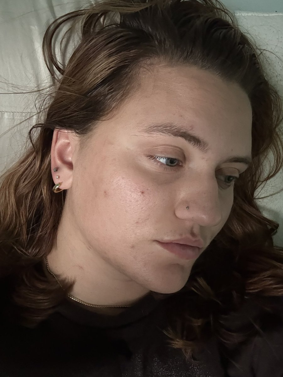 Chloe_k101's tweet photo. Finally got my acne under control and it only took like 6 years 🙈 
#alwayskeepfighting  #acne #face https://t.co/cmjNRpDxGD