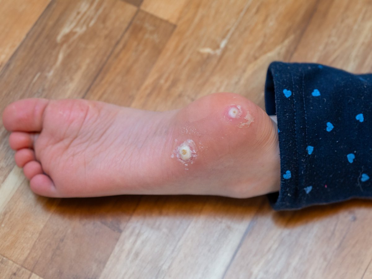 PodiatryMidwest's tweet image. Say goodbye to stubborn foot warts. Our treatments work when over-the-counter fails. #FootSolutions #WartFree
bit.ly/3e2KwaP