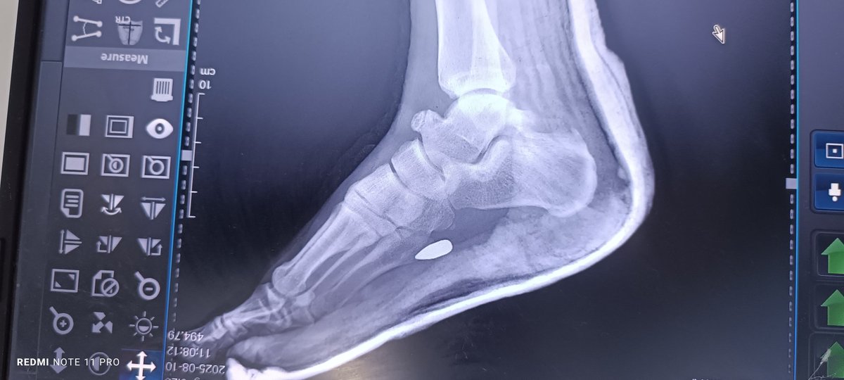 لو تكرمتم اي طبيب مختص يشخص هالاصابة 
طلق ناري .. وهل يمكن استخراج الرصاصة .. 
لانها الها 10ايام برجلي ⁉️