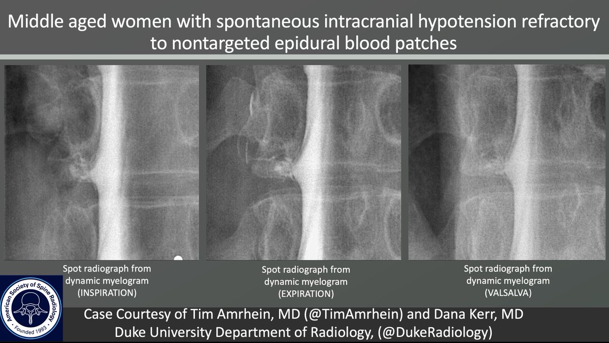 The_ASSR's tweet image. ASSR COTW  

History: Spontaneous intracranial hypotension (SIH) refractory to nontargeted epidural blood patches

Case c/o @TimAmrheinMD from @DukeRadiology 

#SpineRad #NeuroRad #MedEd #FOAMed #FOAMrad #neuroradiology #radiology