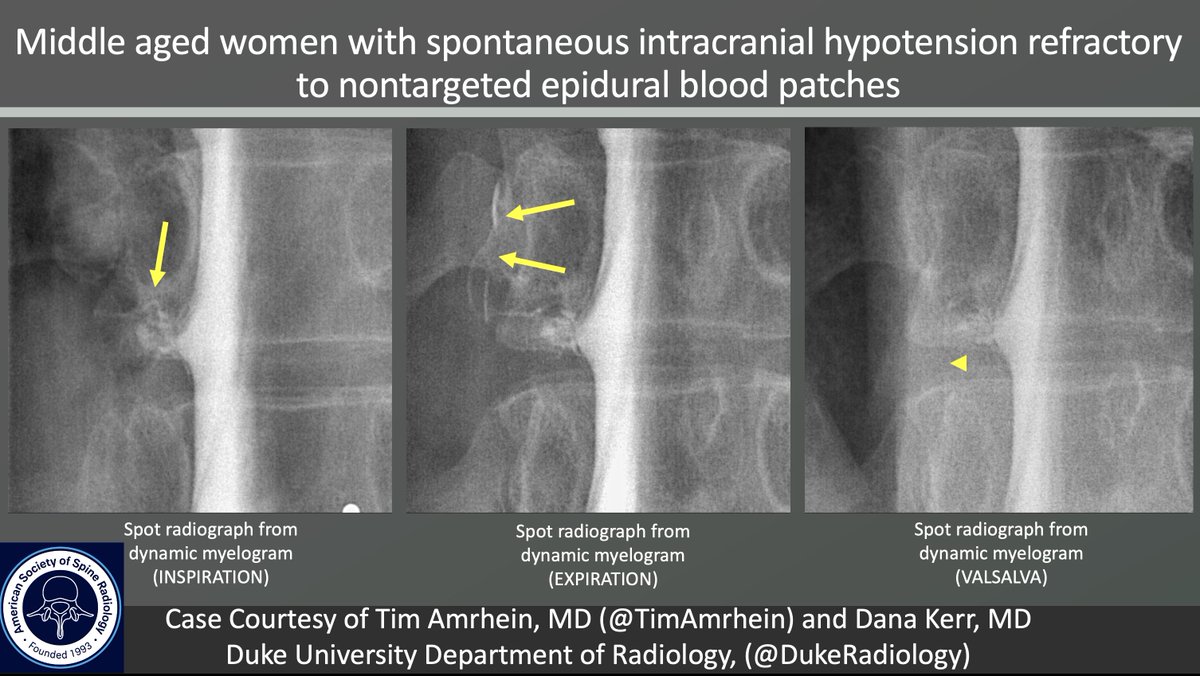The_ASSR's tweet image. ASSR COTW  

History: Spontaneous intracranial hypotension (SIH) refractory to nontargeted epidural blood patches

Case c/o @TimAmrheinMD from @DukeRadiology 

#SpineRad #NeuroRad #MedEd #FOAMed #FOAMrad #neuroradiology #radiology