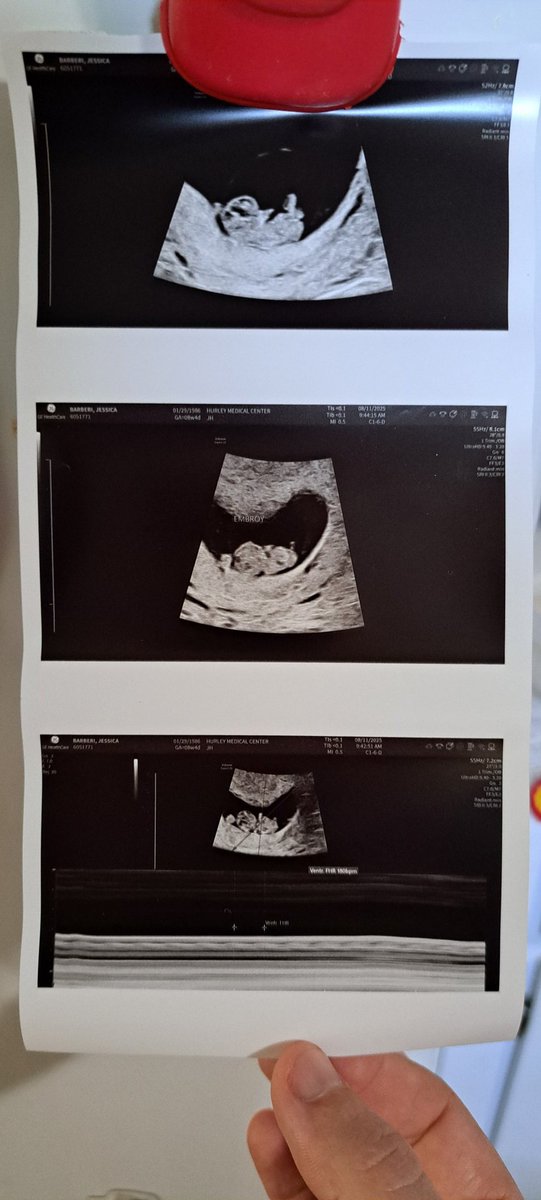 After a miscarriage in October and another in January, I went to my ultrasound appointment, fearing the worst. What saw? A living baby measuring right on track – with a beating heart – waving little arms and legs at me. So here I am celebrating this being, due March next year!