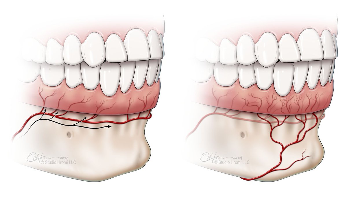 Medillustrates's tweet photo. Emily Hromi’s detailed anatomical illustration compares the vascular supply of the lower gingiva. 

Explore more work by Hromi Biomedical: https://t.co/2Qq3xj5504 

#emilyhromi #medicalillustration #dentalanatomy #gingiva #vascularanatomy #anatomicalillustration #dentistry https://t.co/jGKbVsT8eP
