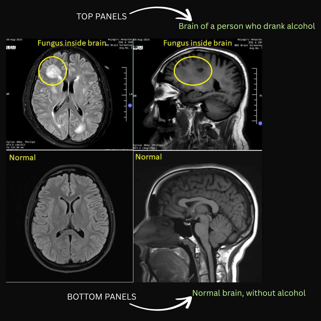 theliverdoc's tweet photo. My patient with alcohol-related liver disease was brought into the emergency in a confused state. Within 24 hours, he crashed in front of the ICU staff, went into a coma, and had to be put on a ventilator.

This is what his brain looked like. A fungus was eating large parts of his right brain. The same fungus was in his blood and lungs too. A little demon called Aspergillus. My patient has non-stop seizures on the ventilator. He is deeply sedated. We are aggressive, but his chances of surviving this fungus assault is slim.

People always equate alcohol use with liver disease. But if you ask me, I am least bothered the liver. Because what alcohol does to your immune system is far more terrifying.

1️⃣Alcohol weakens your body’s defences. Even one moderate drinking session can slow how white blood cells find and kill germs.

2️⃣In the lungs, alcohol harms the “clean-up” cells and blunts the alarms that call in help. With these first-line defences down, bacteria and viruses get a head start.

3️⃣Heavy drinkers get pneumonia more often and recover more slowly. They’re also more likely to develop dangerous lung failure (ARDS) during severe illness.

4️⃣Alcohol use raises the risk of serious brain infections like bacterial meningitis and fungal abscesses. When meningitis occurs in drinkers, outcomes are usually worse.

5️⃣Drinking increases the chance of blood infections. In the ICU, people with alcohol dependence have more complications and higher death rates.

6️⃣Alcohol slows wound healing and increases wound and surgical-site infections. Even around two or more drinks a day is linked to more postoperative infections.

7️⃣Alcohol makes the gut “leaky” and disrupts healthy gut bacteria. Germ fragments and toxins then enter the bloodstream, driving inflammation and setting up infections in other organs.

8️⃣Alcohol weakens the immune system’s ability to make strong antibodies. Responses to vaccines and some viral infections are often poorer, especially with heavy use.

There is no safe level of alcohol that benefits health.
There is nothing known as "responsible drinking". If you are drinking, you are irresponsible. Period.