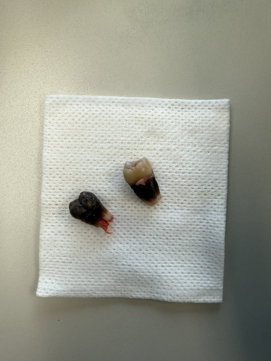 brekevin's tweet photo. Tetracycline staining of impacted wisdom teeth. Crown of #17 and roots of #16. Likely exposure at 11 or 12 years old https://t.co/2TlHWbpJXF