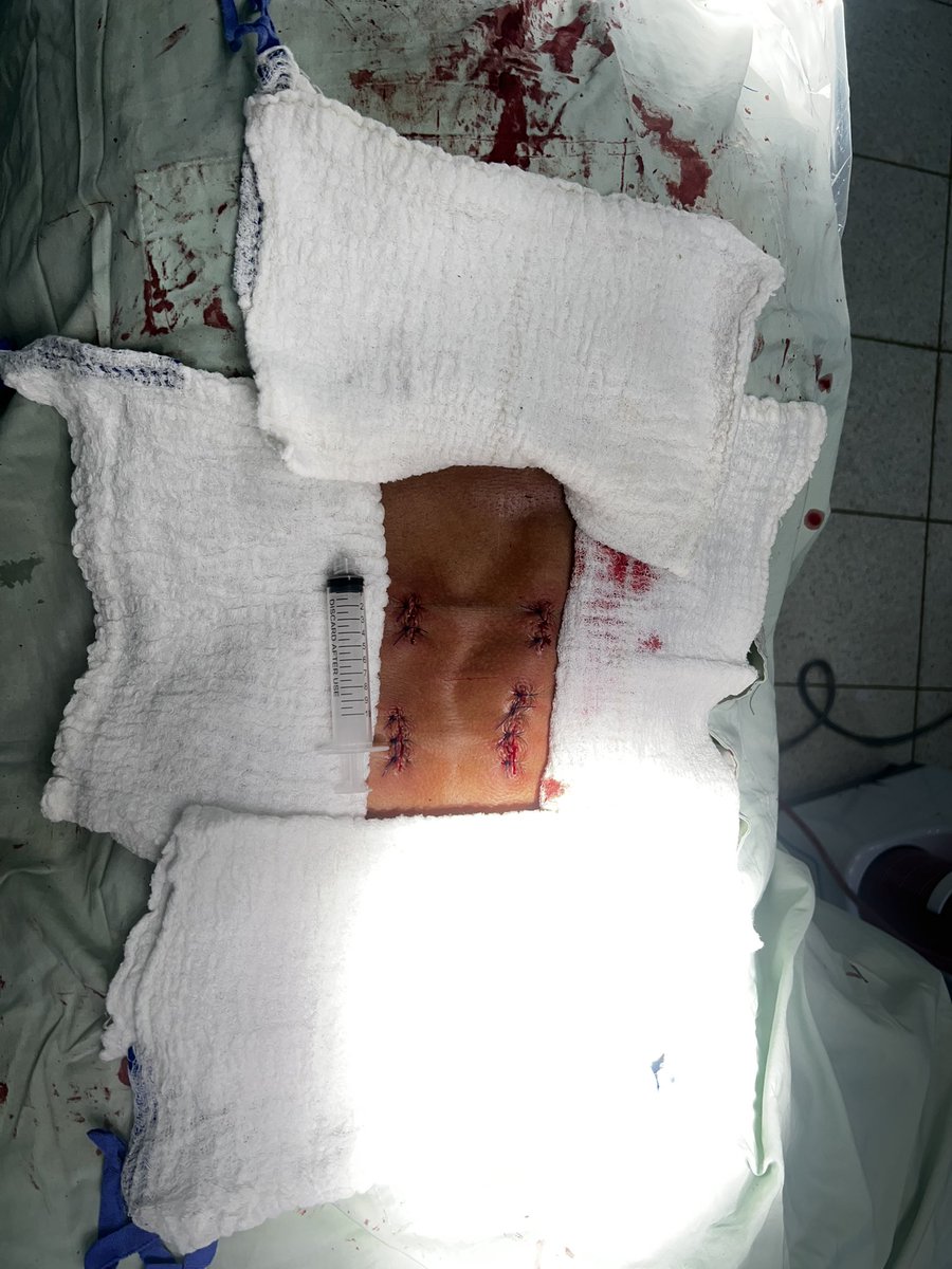 🏥Avances en #neurocirugía que transforman vidas en el HRMM.
En las últimas horas realizamos intervenciones quirúrgicas de columna que, le devolvieron la vida y la esperanza a 2 de nuestros usuarios.
<a href="/giovannyrubiano/">Giovanny Rubiano MD</a> <a href="/Supersalud/">Supersalud</a> <a href="/infopresidencia/">Presidencia Colombia 🇨🇴</a> <a href="/MinSaludCol/">MinSalud Colombia 🇨🇴</a> <a href="/LuisTorreSalud/">Luis Torres Castro - .</a>