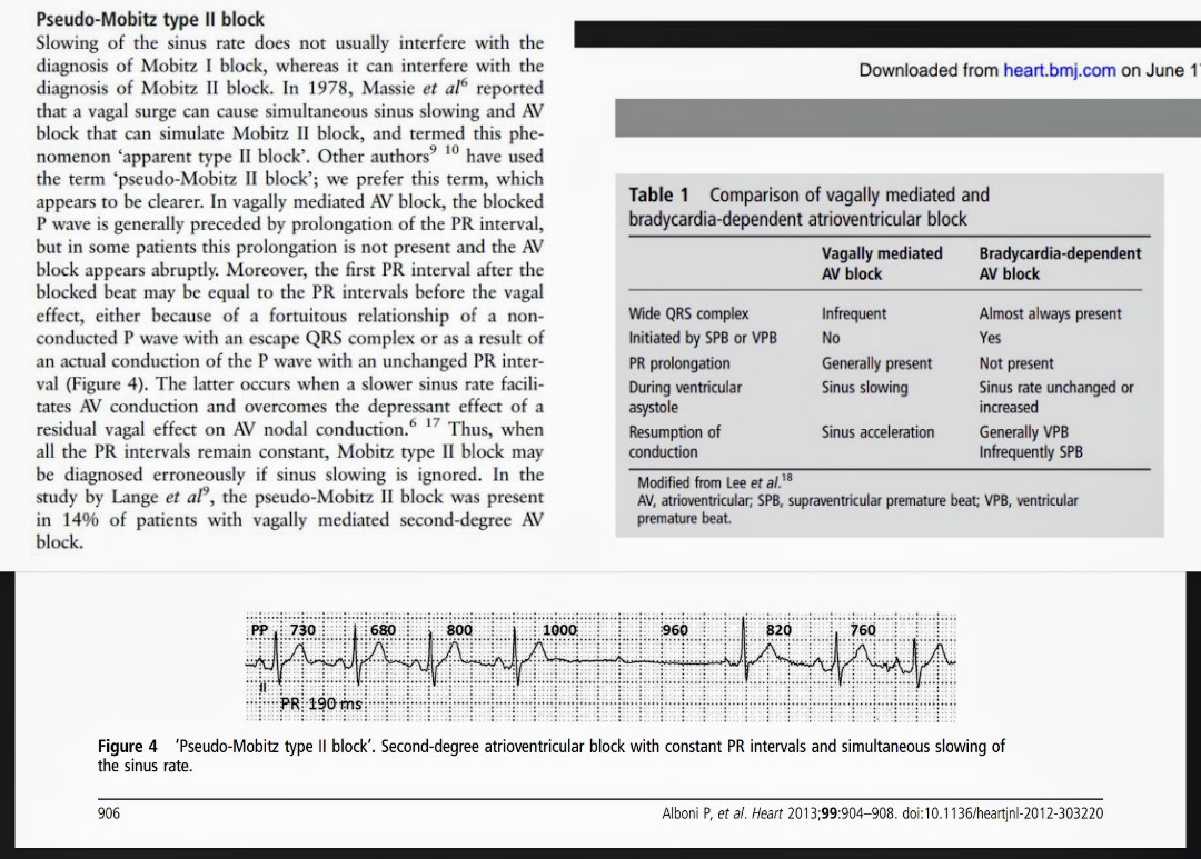 Pseudo-Mobitz type II block ❗ 
Quote: "Thus, when all the PR intervals remain constant, Mobitz type II block maybe diagnosed erroneously if sinus slowing is ignored."
pubmed.ncbi.nlm.nih.gov/23286970/