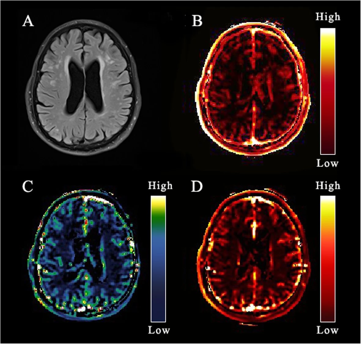 In a study of 97 people with #LongCOVID and 31 recovered controls, non-contrast MRI revealed persistent blood–brain barrier (BBB) leakiness in LongCOVID almost 3 years after infection. 

➡️ Greater BBB permeability was linked to poorer motor function, post-exertional malaise and