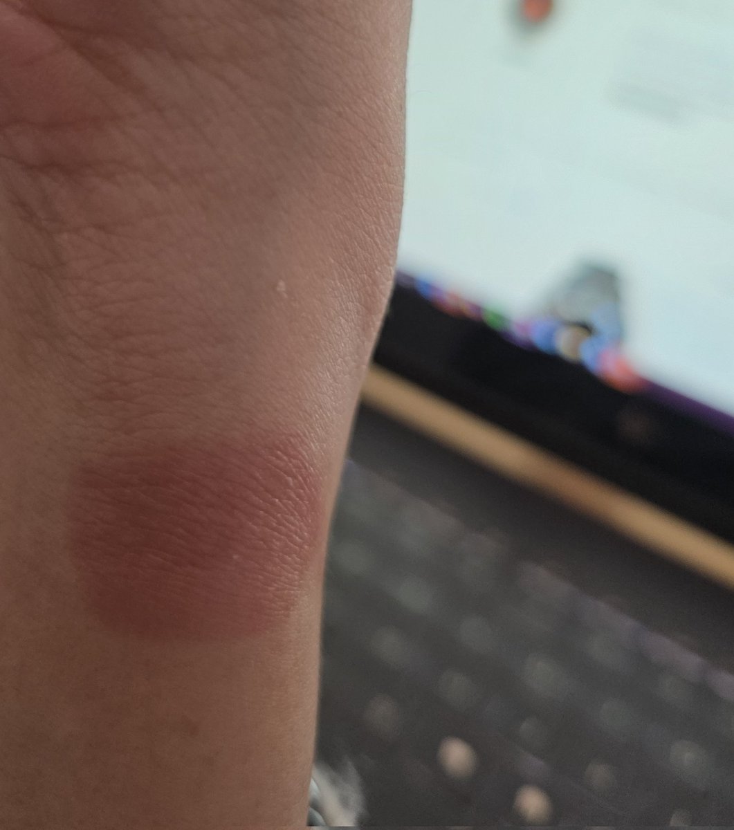 MiellyBb's tweet photo. @GarminMexico @Garmin Amo sus productos. Tengo un Venu 2S, la semana pasada reporté falla en batería y hoy el reloj me provocó una quemadura en la muñeca. Esto es muy grave, ya no sólo es el dispositivo, pudo ser más grave si no lo quito a tiempo @Profeco @AtencionProfeco #help https://t.co/Mw7gFdX5UN
