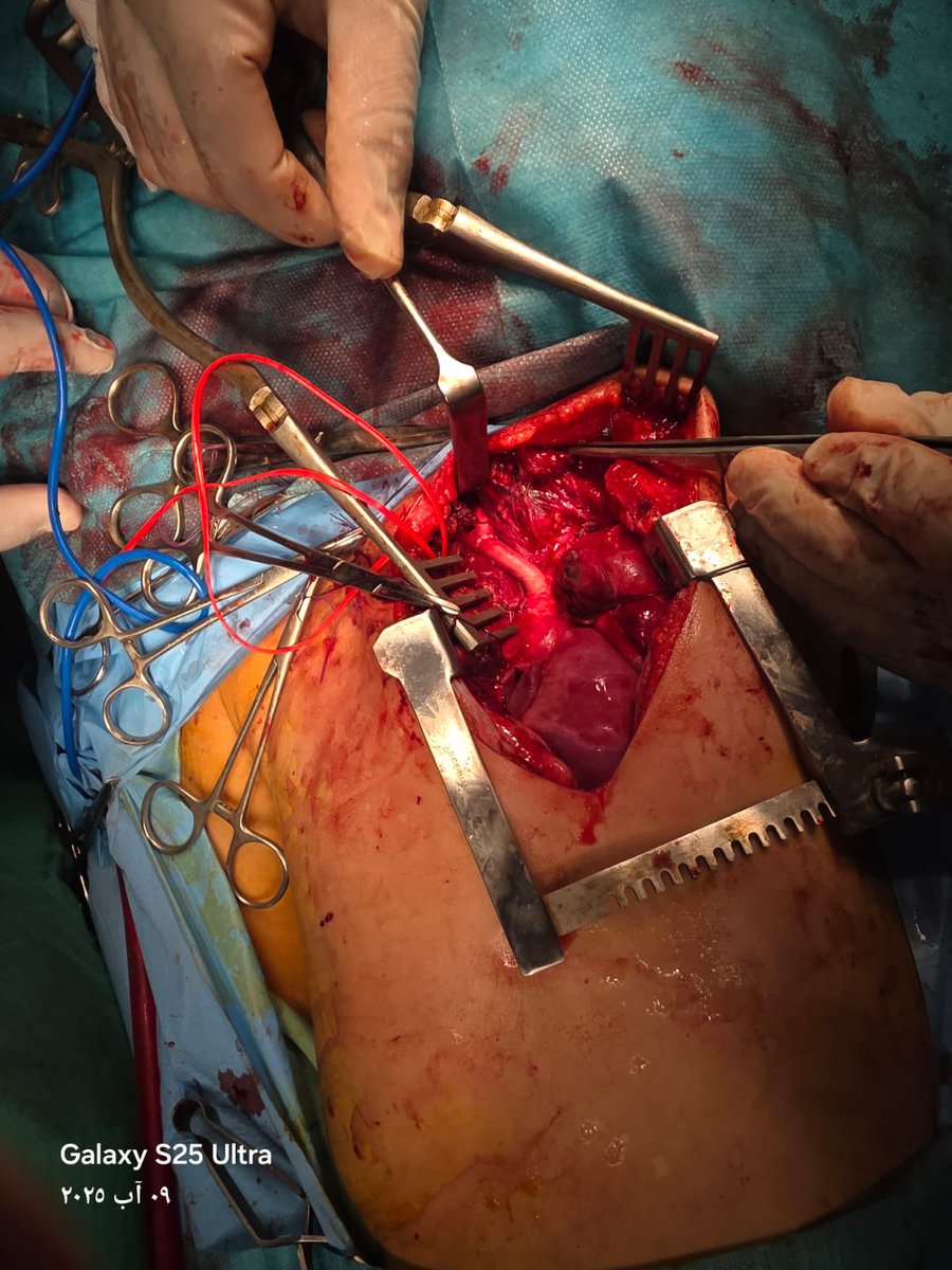 اليوم فجرا طفل بعمر ٤ سنوات تعرض لعيار ناري وهو في خيمته في غز.ة والإصابة كانت في شريان رئيسي خارج من القلب brachiocephalic trunk. 

كيان غاصب محتل تفوح رائحة الحقد والضغينة منهم، جبناء لا رجال فيهم وليس برجل من يخشى قول ذلك في وجوههم. العالم بأكمله يعلم ذلك ويريد قول ذلك لكن