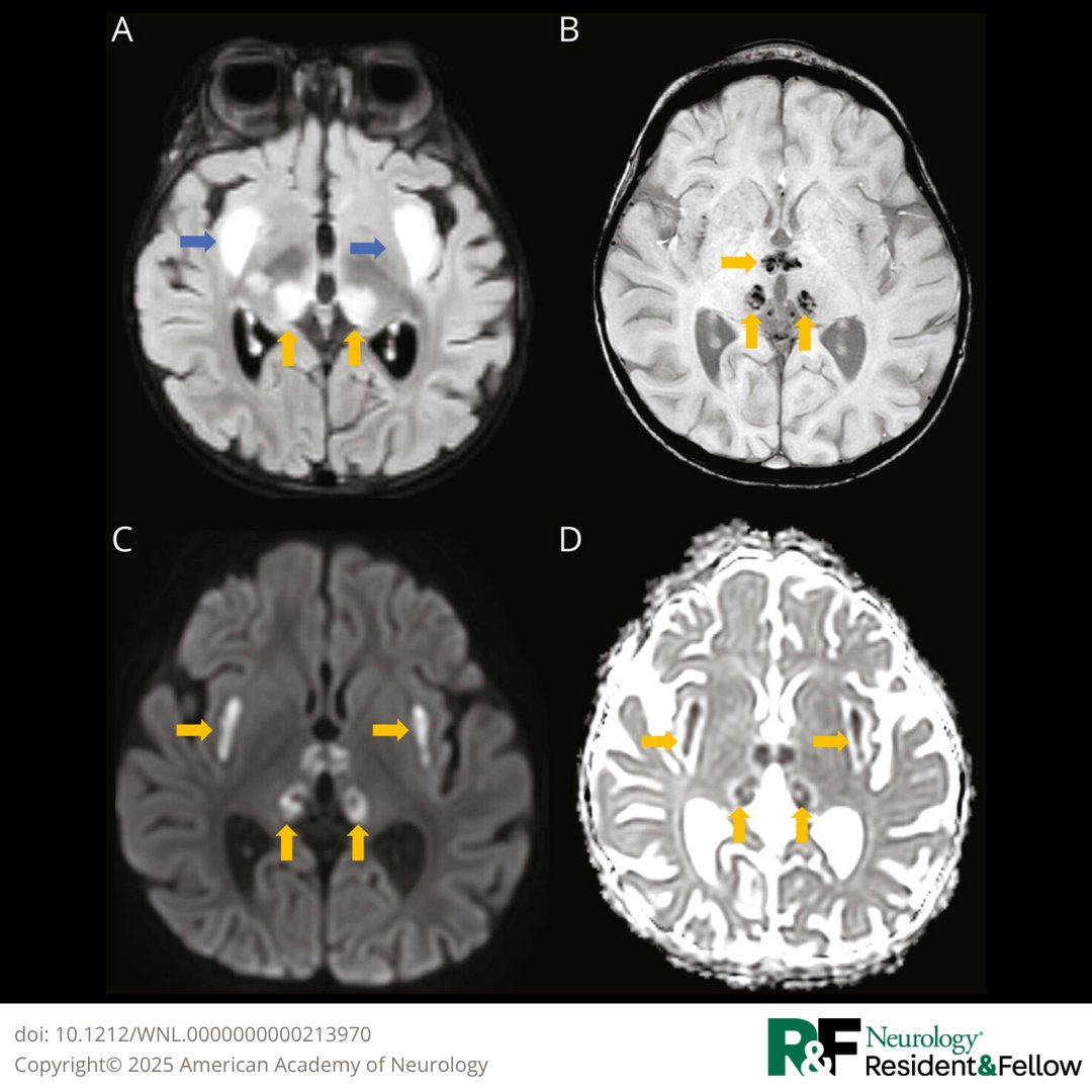 GreenJournal's tweet photo. A 2-year-old girl presented with an acute encephalopathy with hemiparesis after febrile systemic illness. MRI showed multifocal symmetrical lesions in both thalami, CSF showed a slightly elevated protein. Test your clinical reasoning skills: https://t.co/8U8pETKjxz

#NeurologyRF https://t.co/ZKnth2BsfY