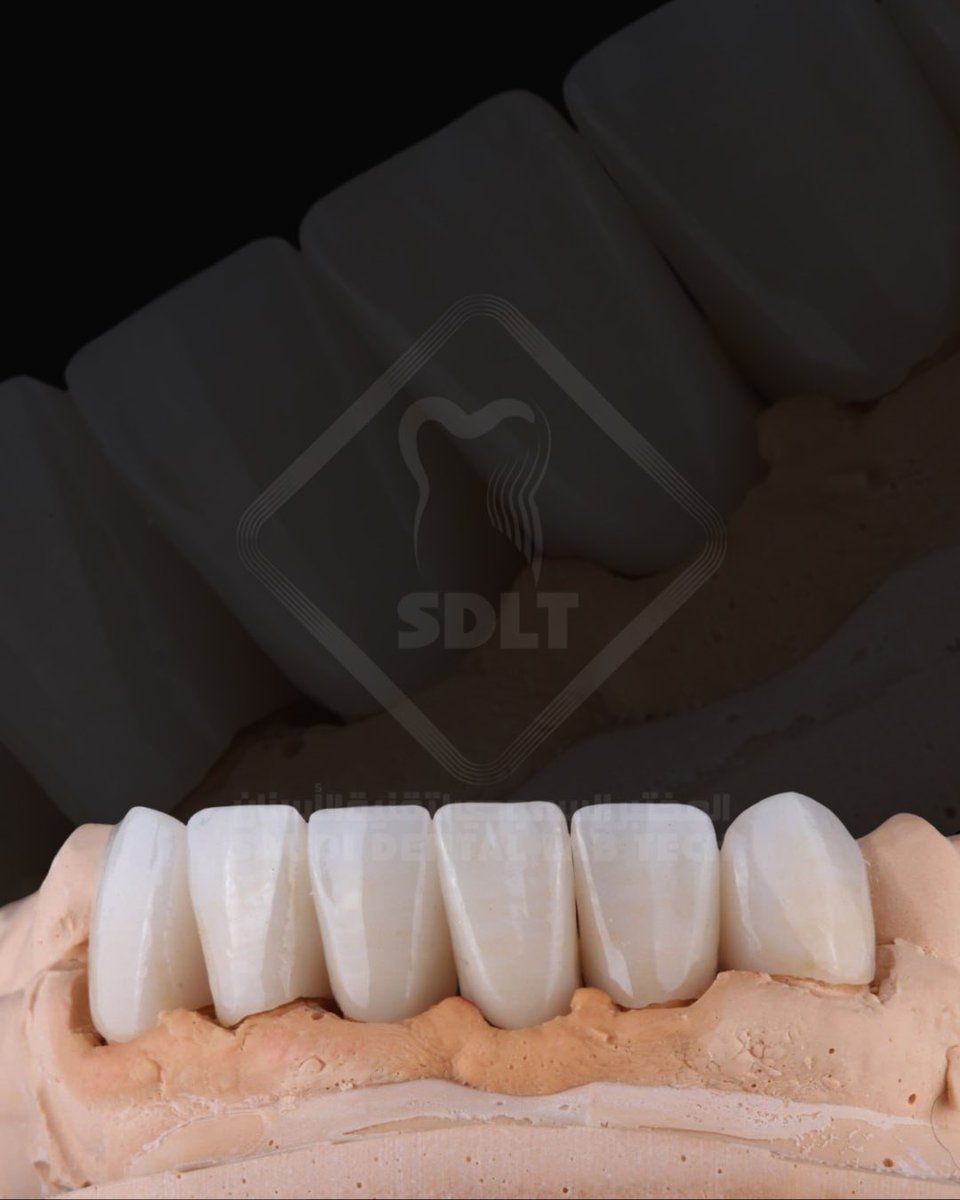 saudi_lab's tweet photo. ZZircam Z-ML code **127
احد منتجات الزيركام التي تتميز بالقوة والجمالية وتصنف انها وظفية تجميلية، يمتاز هذا المنتج بأنه ذو قساوة واحدة ولون متدرج.
.
.
#dental #المختبر_السعودي_لتقنية_الاسنان #تركيبات_اسنان #عيادة_الأسنان https://t.co/fzBN93JFRE
