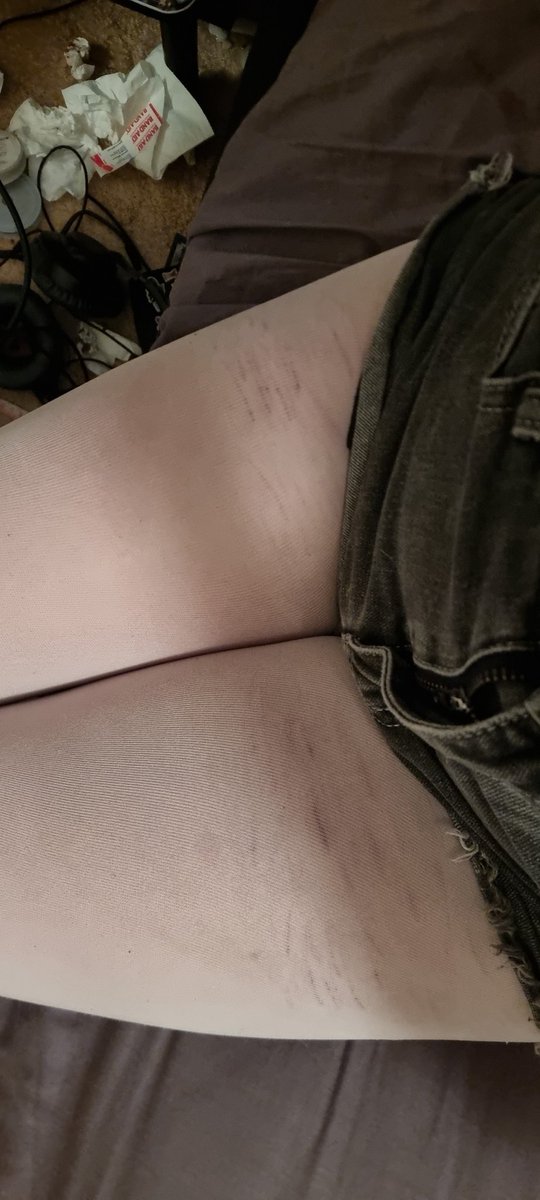 Autoreactivity's tweet photo. you can so easily tell i cut myself through these tights wtf

#shedtwt #slittwt #988shtwt #shtwt https://t.co/97hbFv9eZk