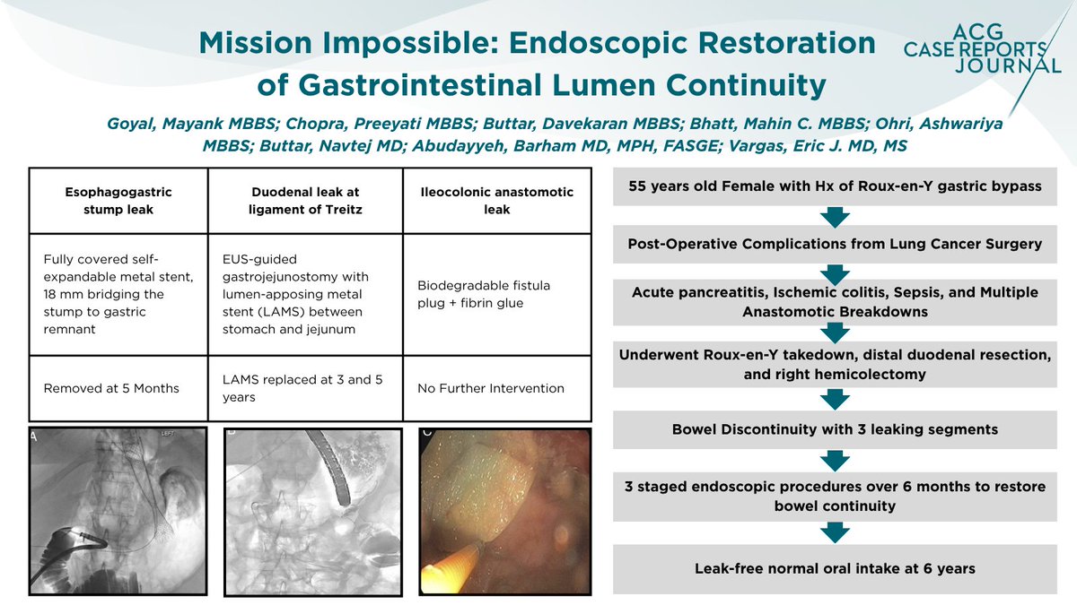 🚨 Editor’s Pick of the Month 
55F, Hx of RYGB → severe post-op complications → 3 disconnected, leaking bowel segments
👨‍⚕️ 3-stage endoscopic repair (FCSEMS, LAMS, Fistula Plug/Glue) 
✅ Leak-free at 6 years, normal oral intake #GITwitter 
tinyurl.com/ycy4f768