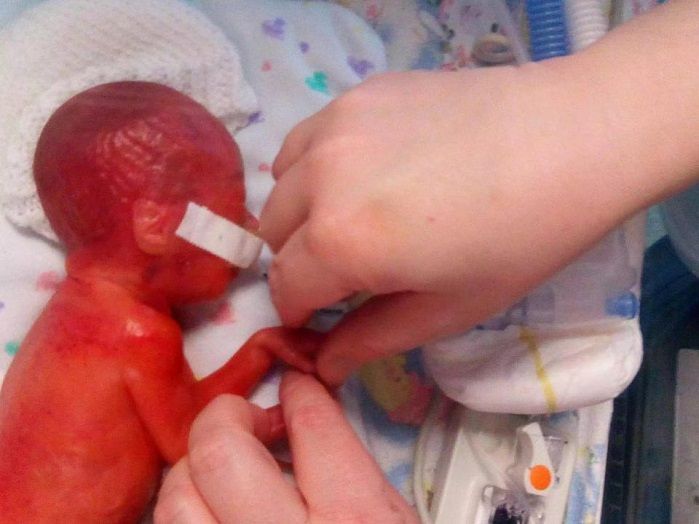 Baby Born On Day Before Abortion Limit Survives, Her Skin Was So Thin You Can See Her Brain buff.ly/k8n5vBa