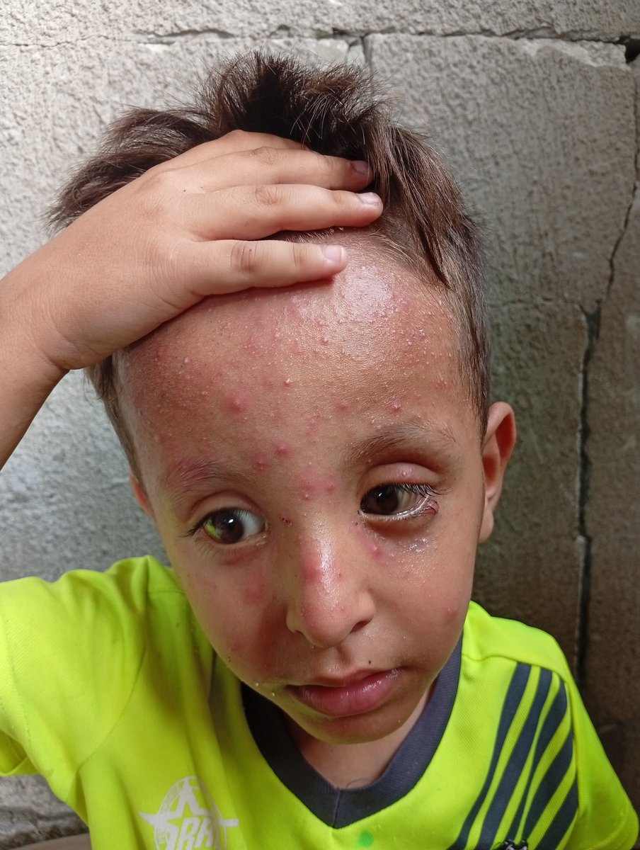 Hello, world, where is the humanity? My brother is sick and there is no money to buy medicine. I ask everyone to donate to save my brother. He is in a very bad condition. Please help us and donate., 💔😭😩
chuffed.org/project/136803…