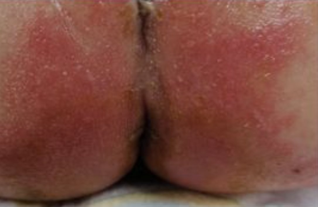 Images_Case's tweet photo. Anal Streptococcal Infection in Newborns: Anal streptococcal anitis is a clinically well-defined entity. However, poorly understood, its diagnosis is often made late, exposing the child to the usual complications of streptococcal infections...https://t.co/k841RshhWv https://t.co/J1WNQ7aPho