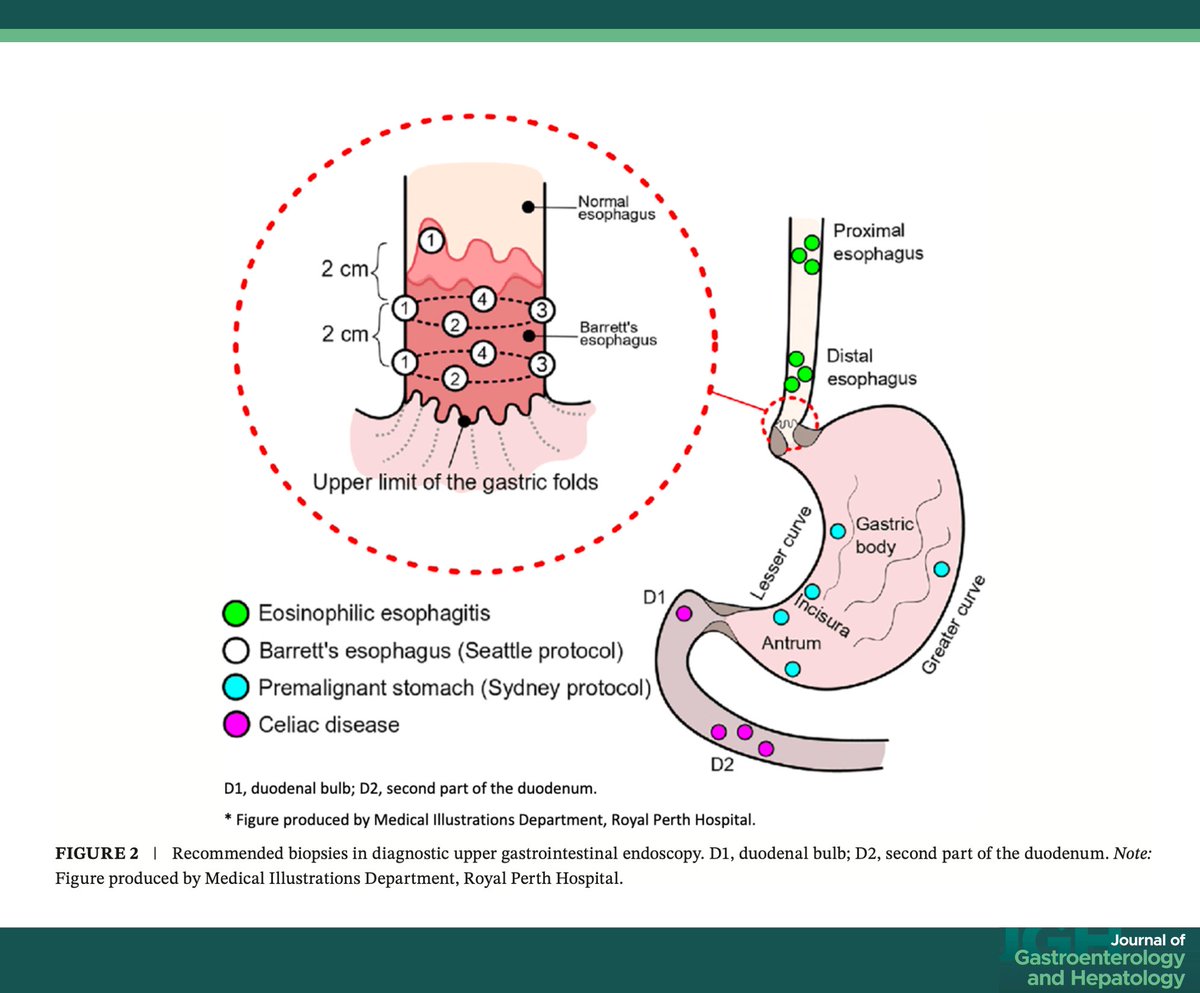 JGHofficial's tweet photo. 🔍 Quality standards for Upper GI Endoscopy!
Gastroenterological Society of Australia and partners release quality benchmarks to ensure safe, high-quality, and equitable care across 🇦🇺 &amp; 🇳🇿

📄 What to biopsy, document, minimum procedure time, and more 👉 https://t.co/IfOqSdEf6K https://t.co/PZr6ekidmH