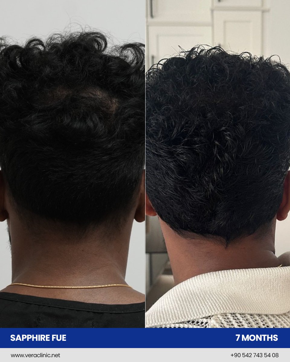 From hairline design to a full, natural look  just 7 months after a Sapphire FUE hair transplant at Vera Clinic. 🌟
Experience minimally invasive treatment, faster healing, and outstanding density with our award-winning team.

📍 Istanbul, Turkey | 🌐 veraclinic.net