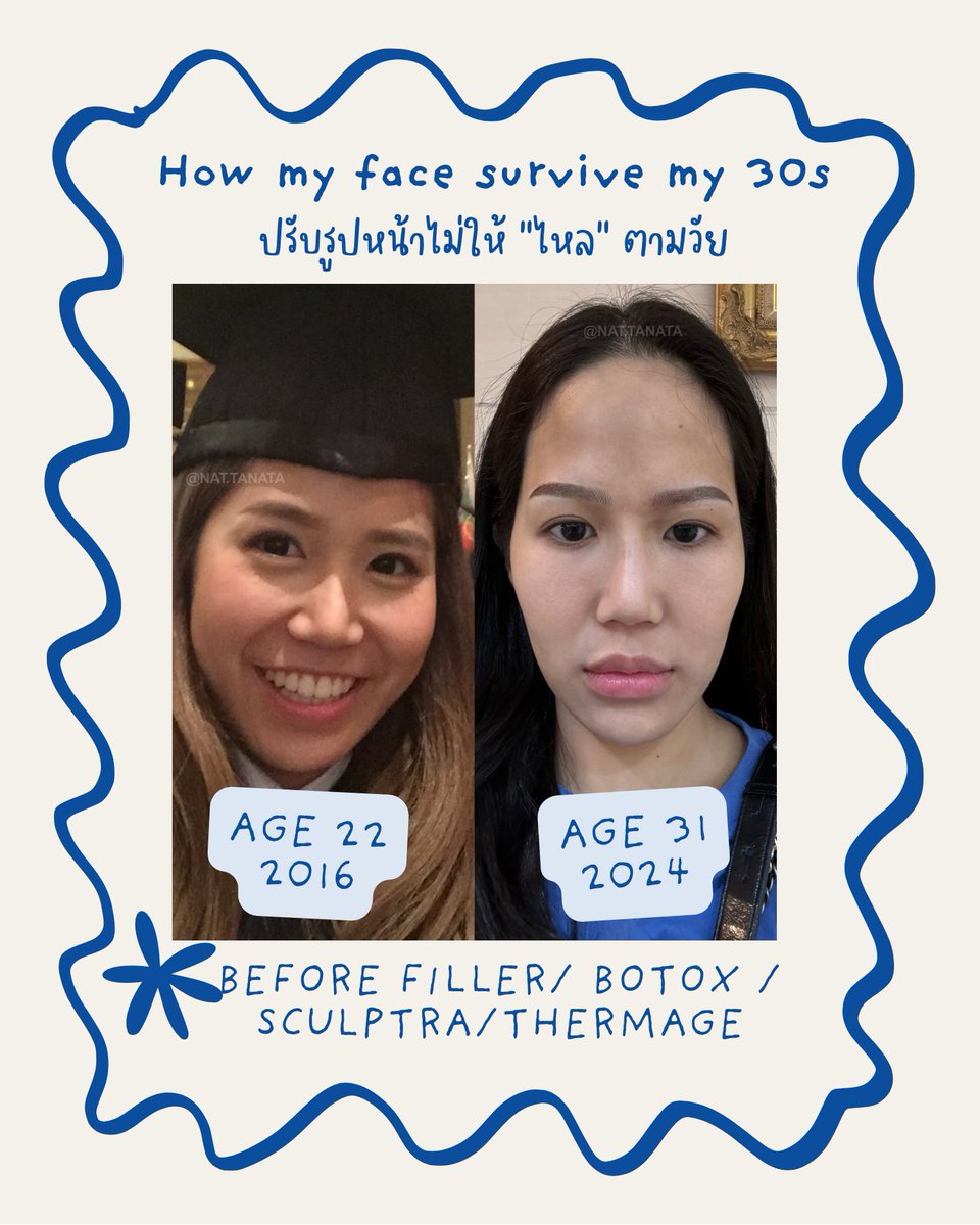 nat_tanata's tweet image. เรื่องโครงหน้ากับรูปหน้า มีผลกับอายุหน้าได้จริงๆนะ ลองแก้มาเองกับตัวแล้วเห็นผลมากก (ผลงานคุณหมอคิม dr.kim_katewadee V square กับคุณหมอกุหลาบ Aes Class Chidlom ONLY) ♥️♥️
