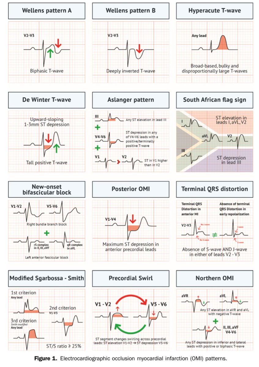 Diego Segura-Rodríguez (@seguracardio) on Twitter photo ⚡️#ECG patterns in occlusion myocardial infarction 
The definitive cheatsheet👇
#ECG ⚡️#ECG patterns in occlusion myocardial infarction 
The definitive cheatsheet👇
#ECG