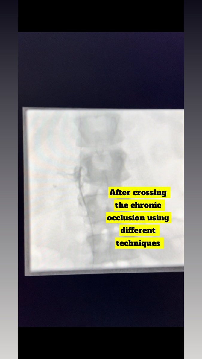 10M3zi's tweet image. مريضة من ذوي الاحتياجات الخاصة تعيش في قرية صغيرة خارج الرياض تعاني من البدانةالمفرطة . تعرضت لتجلطات حادة في الاورده السفليه للبطن والحوض وتم التعامل مع الحاله بنجاح من خلال تركيب الدعامات اللازمة مع سحب التجلطات. 
#الأشعة_التداخلية_خيار_أسهل