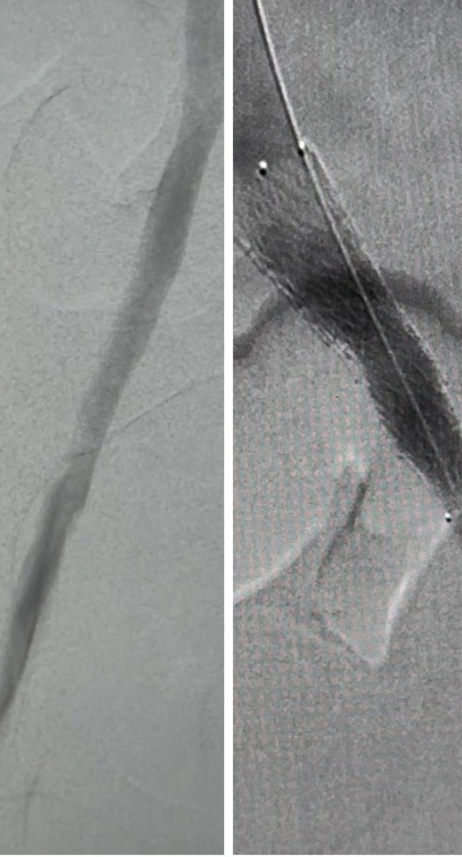 10M3zi's tweet image. مريضة من ذوي الاحتياجات الخاصة تعيش في قرية صغيرة خارج الرياض تعاني من البدانةالمفرطة . تعرضت لتجلطات حادة في الاورده السفليه للبطن والحوض وتم التعامل مع الحاله بنجاح من خلال تركيب الدعامات اللازمة مع سحب التجلطات. 
#الأشعة_التداخلية_خيار_أسهل
