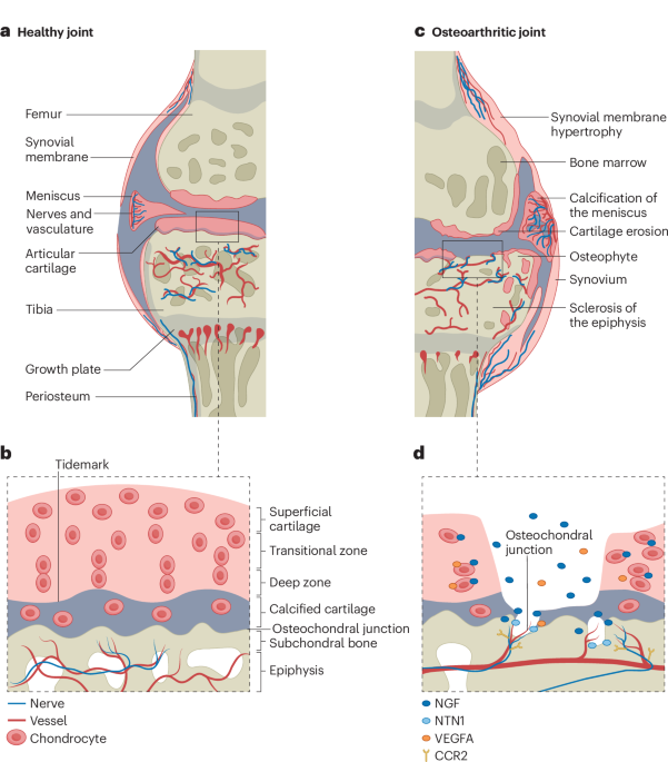 New content online: Peripheral neuronal sensitization and neurovascular remodelling in osteoarthritis pain bit.ly/4oviR5u