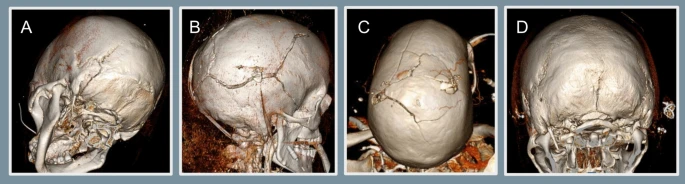 NeurocritCareJ's tweet photo. Huang et al: Traumatic Venous Sinus Thrombosis: Patient and Practice Patterns at a Major Trauma Center

Link: https://t.co/2sDEePJSjQ

@neurocritical #neurocritcare https://t.co/9vhSTZzZwz