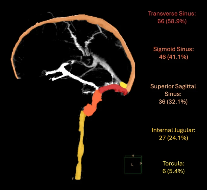 NeurocritCareJ's tweet photo. Huang et al: Traumatic Venous Sinus Thrombosis: Patient and Practice Patterns at a Major Trauma Center

Link: https://t.co/2sDEePJSjQ

@neurocritical #neurocritcare https://t.co/9vhSTZzZwz
