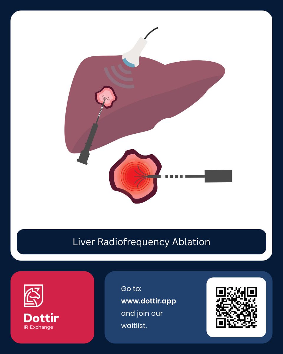 Liver radiofrequency ablation (RFA) is a minimally invasive treatment that uses heat to destroy cancer cells in the liver, targeting tumours precisely while preserving healthy tissue.
It’s ideal for smaller tumours and offers quick recovery with low complication rates. #Dottir