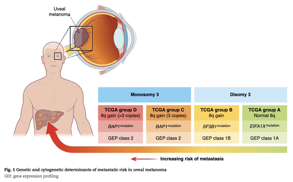 Management of liver metastases from uveal melanoma
➡️ doi.org/10.1093/bjs/zn…

This review discusses the clinical background of uveal melanoma and liver metastasis, the efficacy of systemic and locoregional treatment options, and the development of combining locoregional
