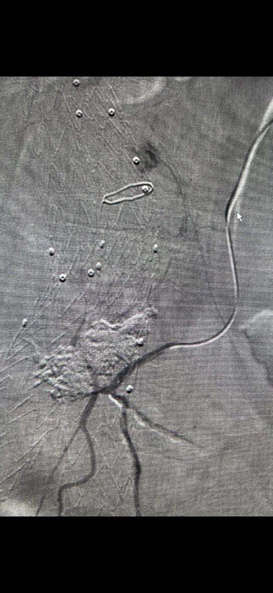 Recurring type 2 only discovered during selective angio. Multiphasic CTA did not show any leak but only increase in size . Onyx used to embolize type 2 in 2022. You could see tiny branch going towards the leak and outflow to Left testicular. Finally reembolization with Onyx.