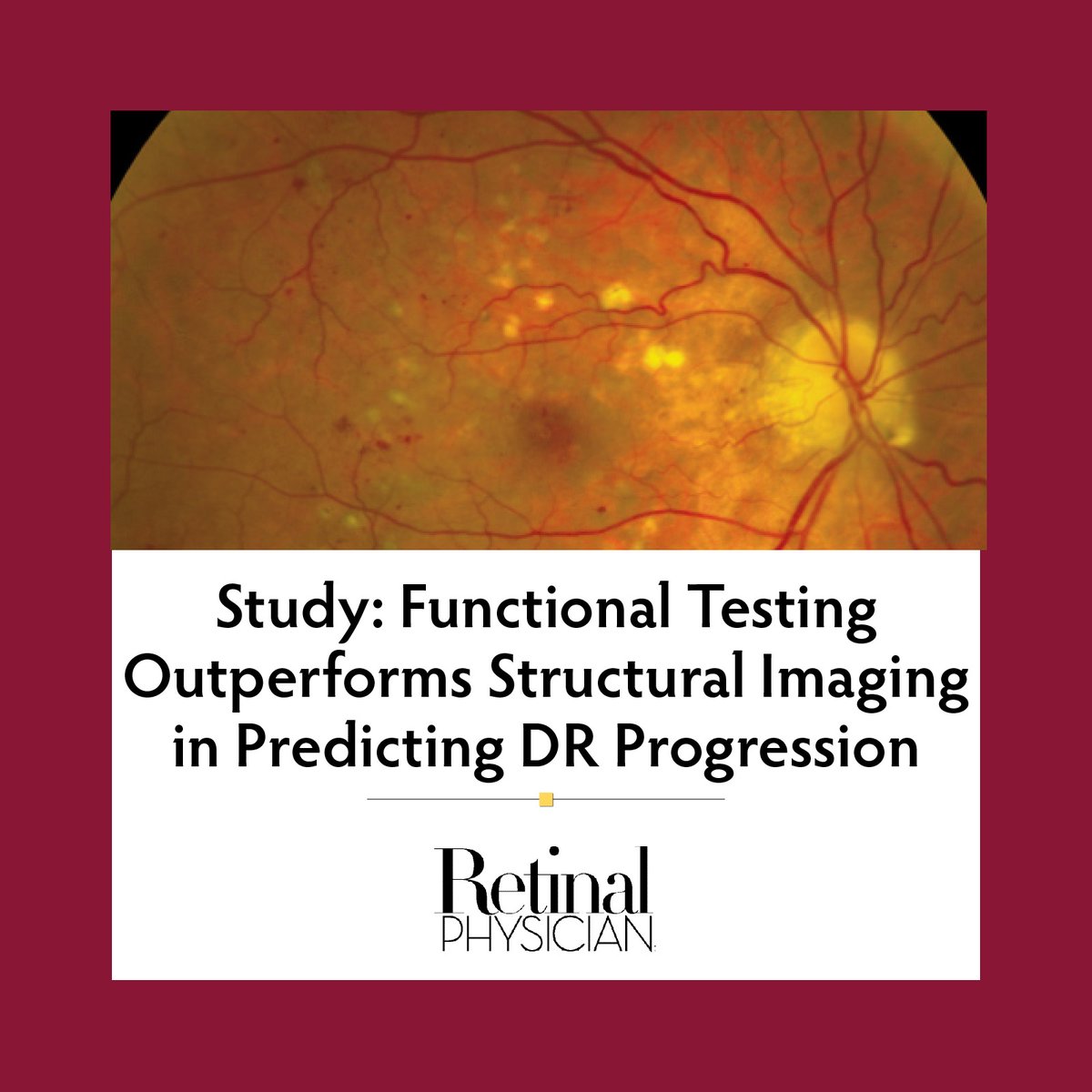 A prospective trial shows that ERG and pupillometry predict progression to vision-threatening diabetic retinopathy more accurately than structural imaging. Read more: ow.ly/pZsb50WEEhT
#RetinalPhysician #electroretinography #LKCTechnologies #diabeticretinopathy #Conexiant