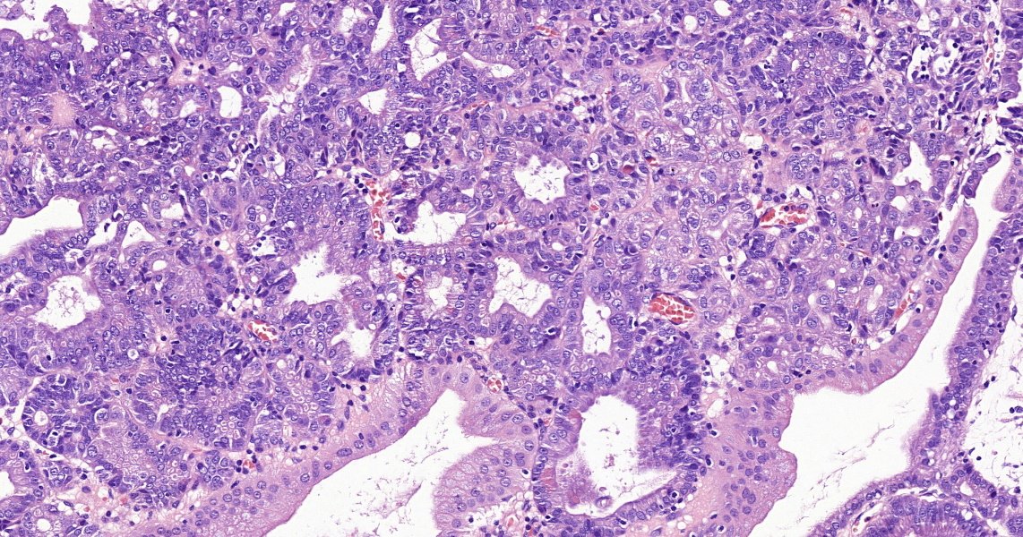 ESP Trainees' Subcommittee (@esptrainee) on Twitter photo #ESPtrainee Case of the Month 📝 by <a href="/AlmasiSzintia/">Almási Szintia</a> A 45-year old male had his gallbladder removed due to gallstones. A polypid lesion measuring 6 mm in diameter was identified during grossing. Take a look at the HE slides and answer questions ⬇️ <a href="/ESP_Pathology/">European Society of Pathology (ESP)</a> #PathX #ESPtrainee Case of the Month 📝 by <a href="/AlmasiSzintia/">Almási Szintia</a> A 45-year old male had his gallbladder removed due to gallstones. A polypid lesion measuring 6 mm in diameter was identified during grossing. Take a look at the HE slides and answer questions ⬇️ <a href="/ESP_Pathology/">European Society of Pathology (ESP)</a> #PathX