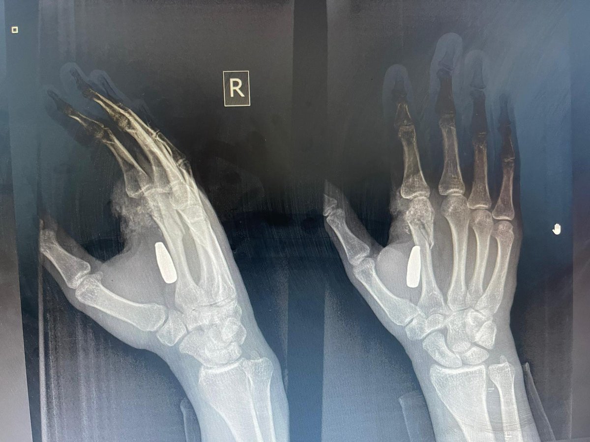 Unfortunately, I was shot in the hand a while ago. Unfortunately, I'm not in the right place, or unfortunately I don't have the money for the operation. We hope you can help me. Pray for me.💔

If you're scrolling, PLEASE leave a dot. it's just a dot
chuffed.org/project/127878