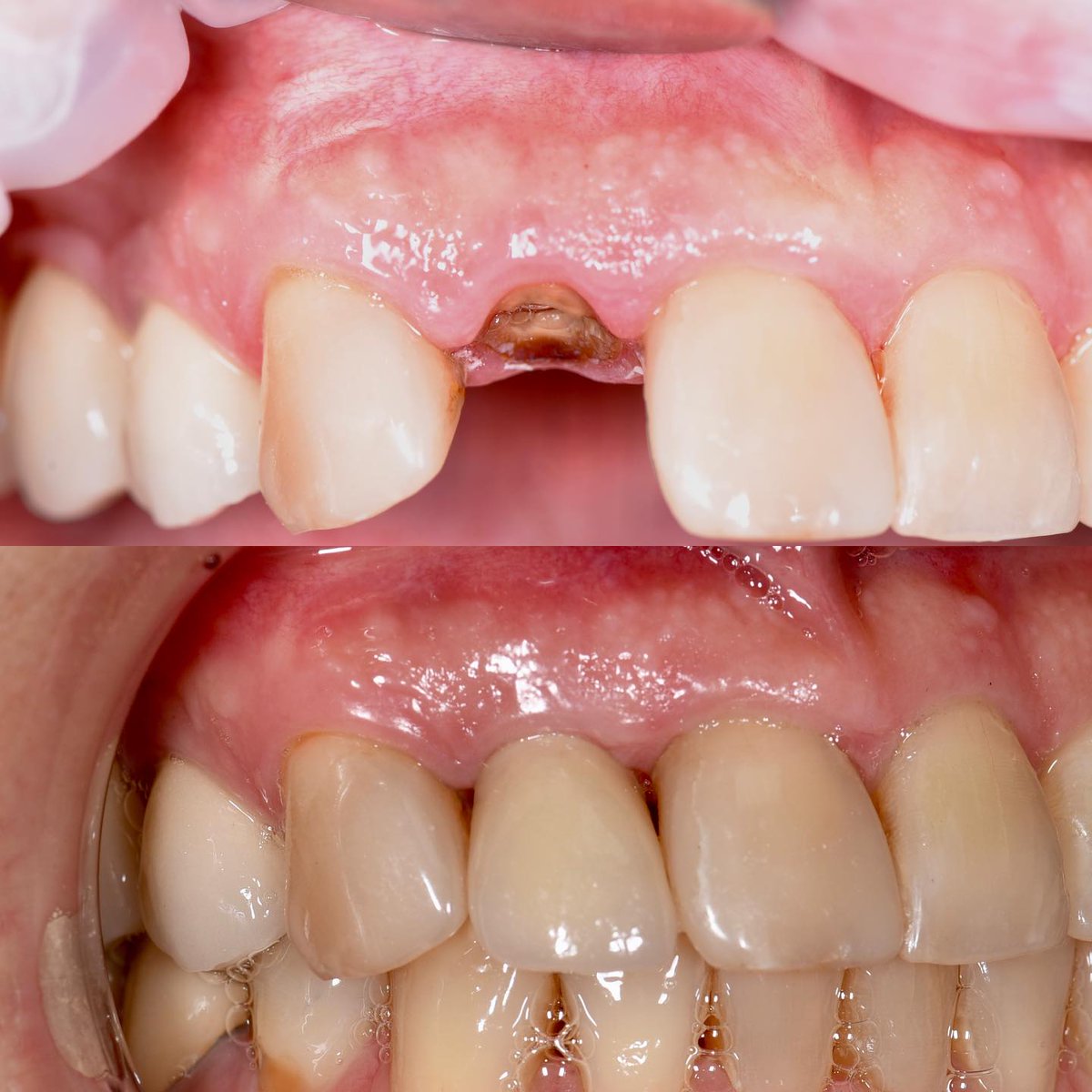 Implantation in an aesthetically significant area