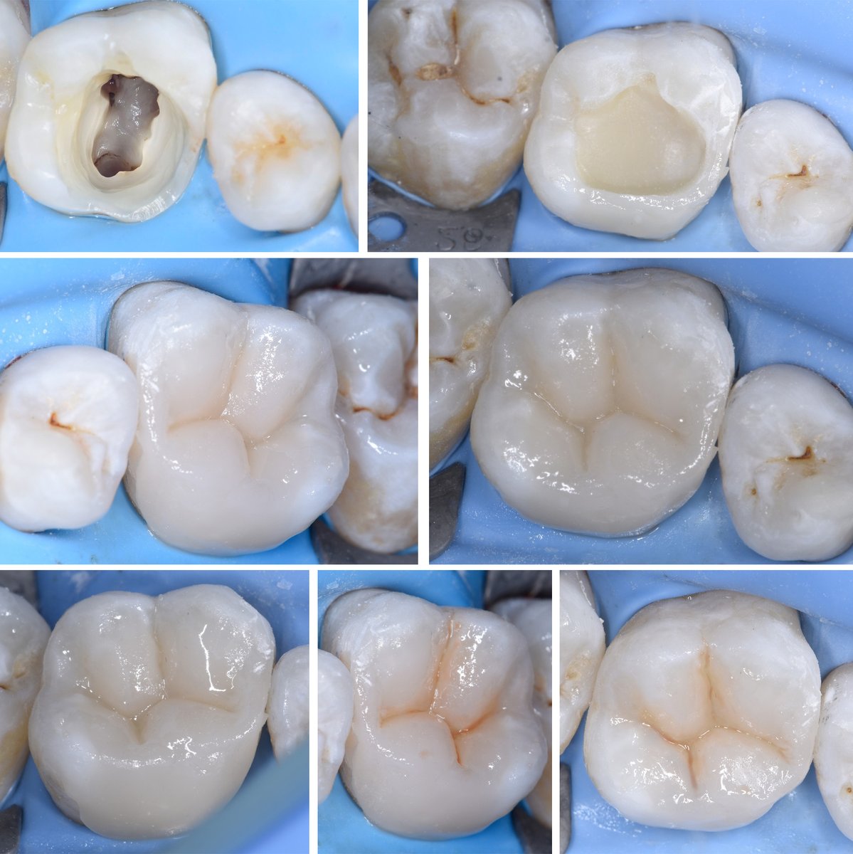 Root canal treatment and Direct composite
