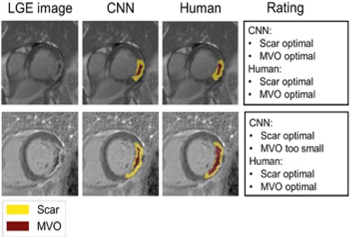 Deep learning tool for automated segmentation of myocardial infarcts on cardiac MRI outperforms trained readers and requires no pre-processing.​
<a href="/RSNA/">RSNA</a> <a href="/OxfordJournals/">Oxford Journals</a> #RadAdv ​
doi.org/10.1093/radadv…