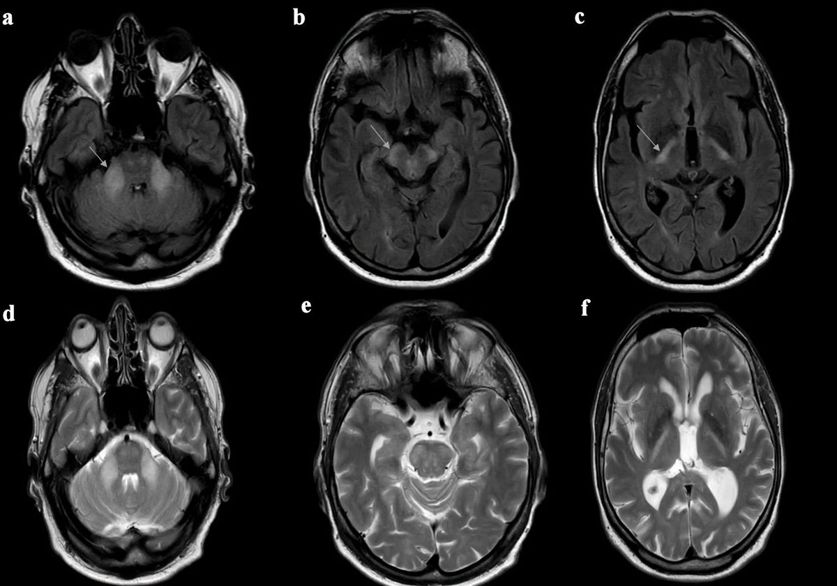 Neuro_Res's tweet photo. Read the #openaccess research:
Late-Onset CLCN2-Related Leukodystrophy Associated With A Novel Mutation
https://t.co/HY2khVoYhC 
Keywords: #Chloride channel #protein 2, #Leukoencephalopathy, #Leukodystrophy https://t.co/J6l23HUkbq