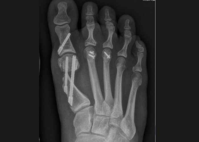 Did you know Minimally Invasive #Bunion Surgery helps you walk earlier than traditional procedures?
✅ Smaller incisions
✅ Less tissue trauma
✅ Faster recovery
✅ Better toe movement

It's foot surgery—with a modern upgrade. medilink.us/xwy3 #orthotwitter