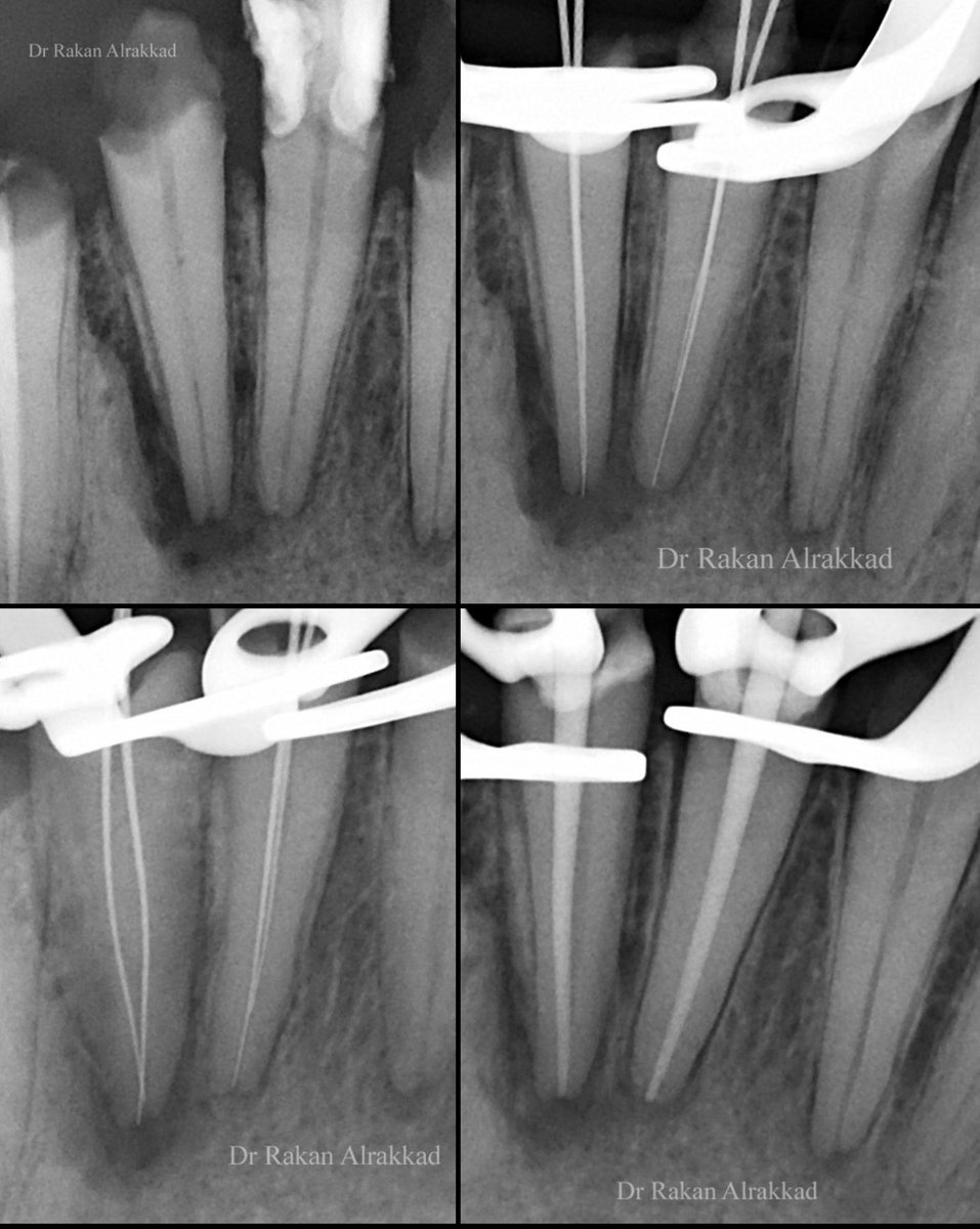 NSRCT for #41,42 🔬