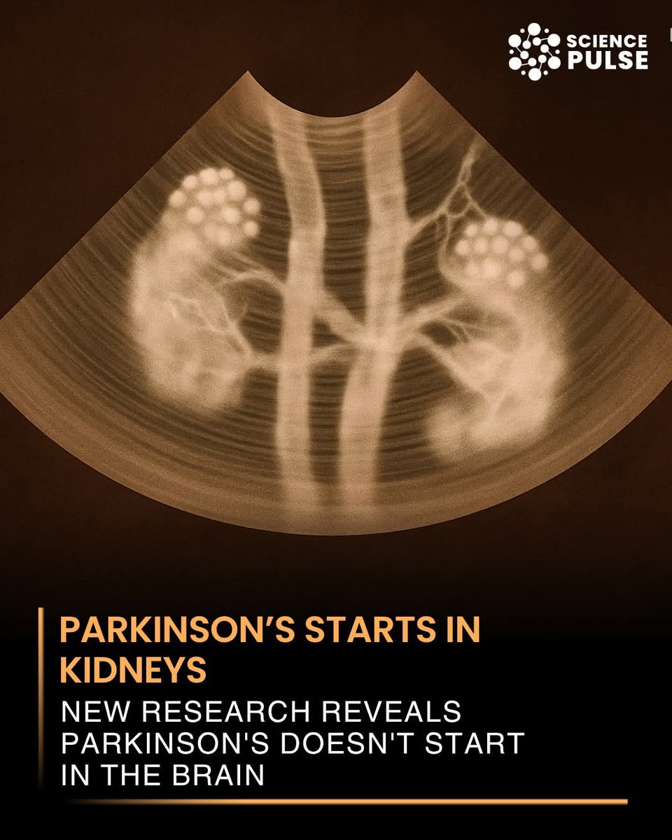 4biddnKnowledge's tweet photo. A groundbreaking study from Wuhan University is turning everything we thought we knew about Parkinson’s disease upside down. Researchers now believe the disease may not start in the brain at all, but in the kidneys.

The study found abnormal clusters of alpha-synuclein (α-Syn) proteins, the same ones heavily linked to Parkinson’s, inside the kidneys of affected patients. These proteins are known to trigger neurological damage when they build up in the brain. However, in animal experiments, healthy kidneys successfully cleared these proteins. When kidney function was impaired, the α-Syn proteins began to travel to the brain, setting the stage for Parkinson’s.

Shockingly, even people with chronic kidney disease but no neurological symptoms were found to have α-Syn buildup. This discovery suggests the kidneys might act as an early “reservoir” for toxic proteins, which could later spread through the bloodstream or nerves and affect the brain.

Though early and based on limited data, this research could completely change how we understand and treat Parkinson’s. It raises the possibility that monitoring and protecting kidney health might one day help prevent or delay the onset of this devastating condition.