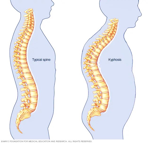 Had0o0716's tweet photo. #ثريد_اليوم

تقوس الظهر (Kyphosis)

هو انحناء غير طبيعي في العمود الفقري يؤدي إلى انحناء الجزء العلوي من الظهر للأمام بشكل زائد ، مما يجعل الظهر يبدو مقوّسًا أو مائلًا للأمام أكثر من الوضع الطبيعي.
1️⃣

#صحتك_تهمنا 
#توعية
#علاج_طبيعي
#PT
#physiotherapy 
@HashKSA 
@Co_aw2 https://t.co/Uq4L8W8YDv