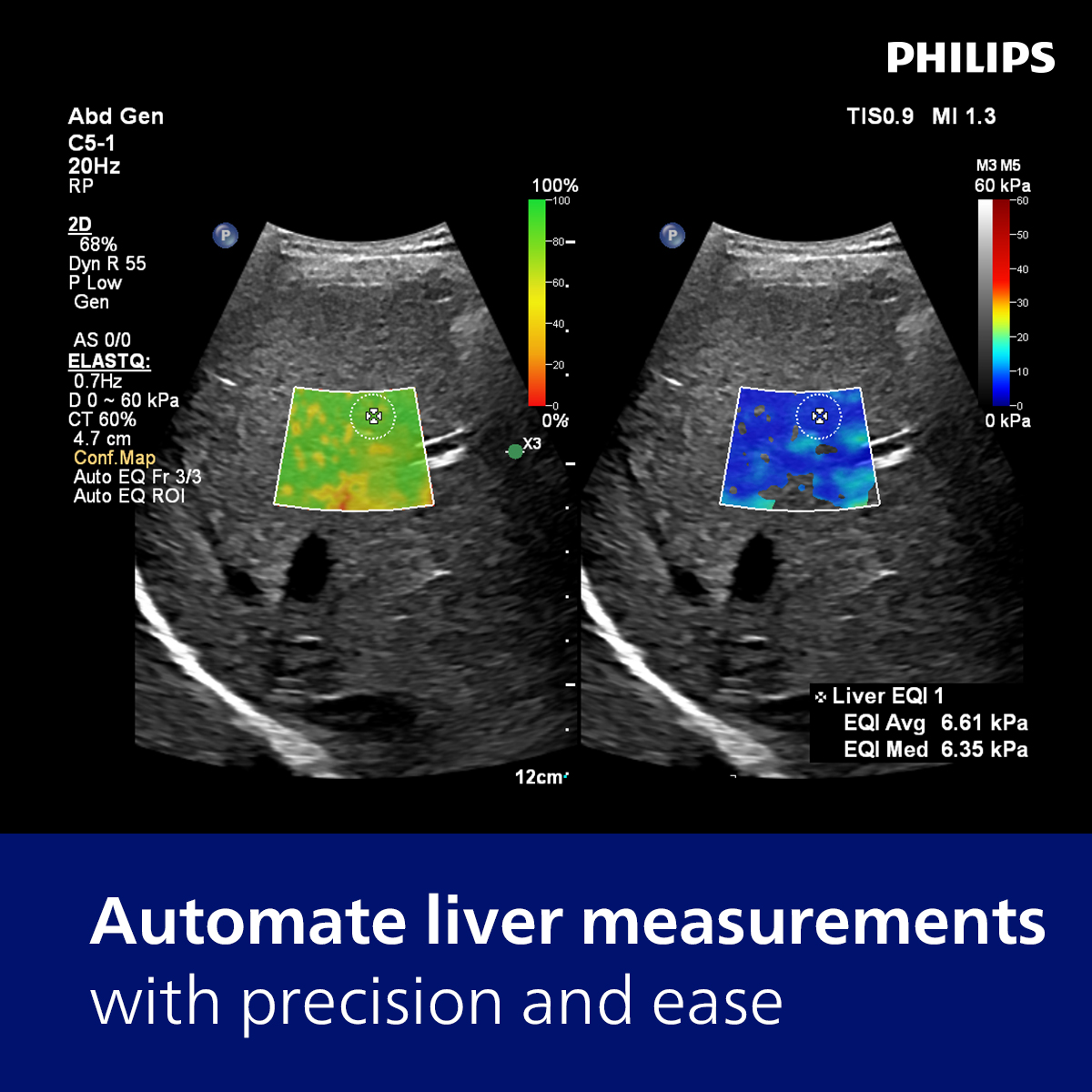UdayPhilipsUS's tweet photo. Auto ElastQ
- 99% reliability in shear wave measurements*​
- 60% less time needed for elastography exams*​
- 29% fewer steps to obtain liver elastography measurements*​
​
*Compared to conventional Philips SWE ElastQ
#Liver #LiverElastography #Philips #sonographer #abdominal https://t.co/AnRTYw8zK0